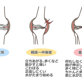 あなたの膝痛はどこから？膝の皿の上下で異なる症状と原因
